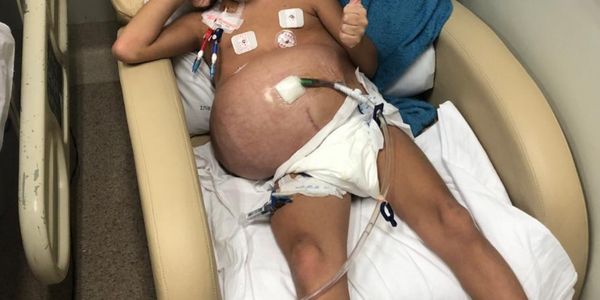 alt="síndrome de prune belly sintomas"